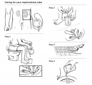 Caring for Your Nephrostomy Tube
