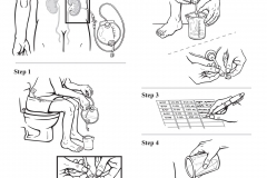 Caring for Your Nephrostomy Tube