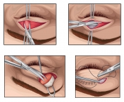 Eyelid surgery