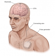 Electrode Implant